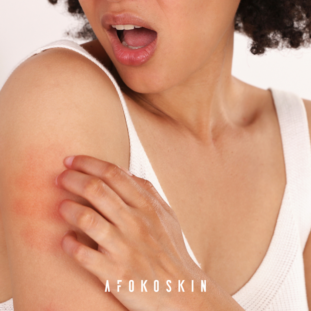 Treating Mosquito Bites on Melanin Skin: Say Goodbye to Scarring and Hyperpigmentation